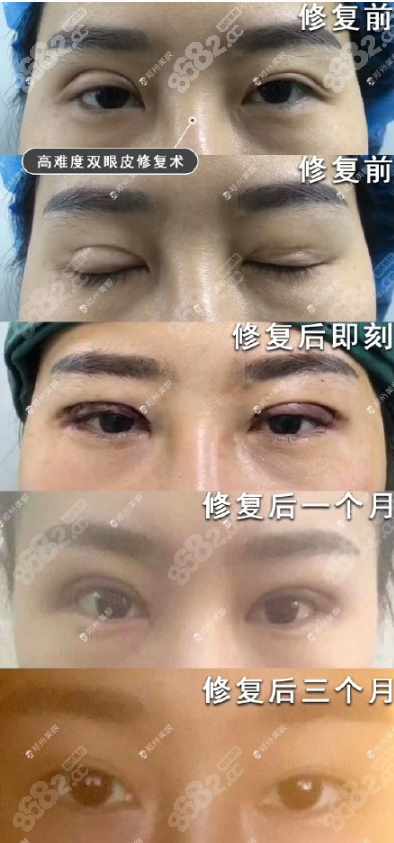 双眼皮术后眼睑外翻修复案例