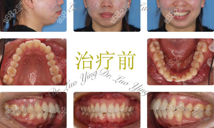 一组杭州正畸医生骆英ebrace舌侧矫正24个月效果图