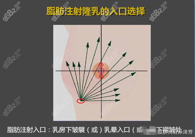 贵妃丰胸脂肪注射隆乳的入口选择