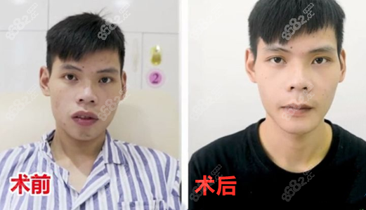 重庆口腔颌面医生王涛做的正颌手术矫正凸嘴脸型变化图
