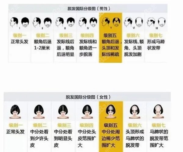 脱发都开始分等级了对比后值得一去的就属济南名韩植发