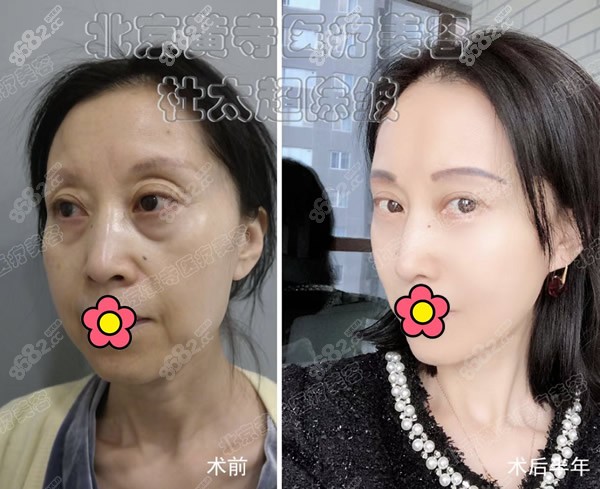 北京黄寺杜太超医生,脸部小切口拉皮除皱手术效果图合集