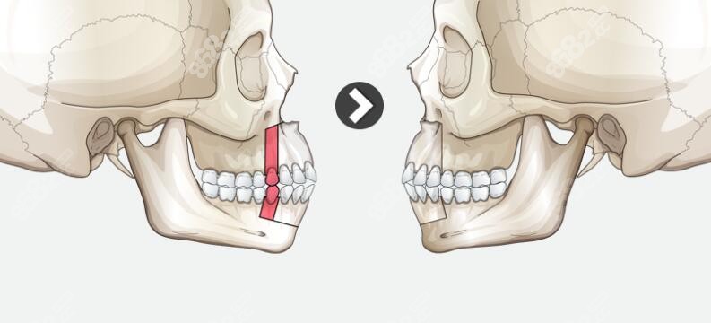 骨性凸嘴正颌手术