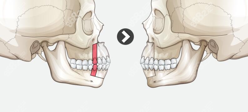 骨性嘴凸正颌费用是不是贵一些