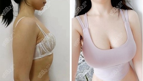 乳房太大如何缩小 乳房缩小术哪家医院好 要多少钱 86赴韩整形网