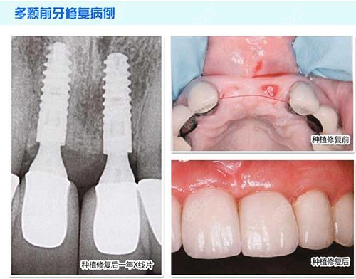 多颗前牙种植案例