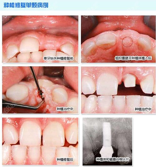单颗种植牙修复案例