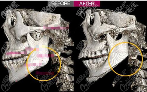 下颌角手术ct图片