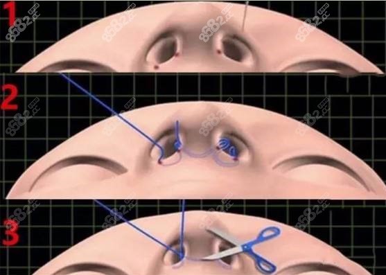 內切法鼻翼縮小術手術原理