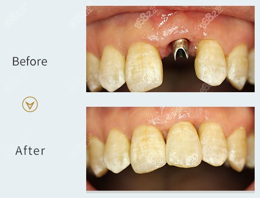北京嘉和口腔醫院瑞士iti種植牙真人案例