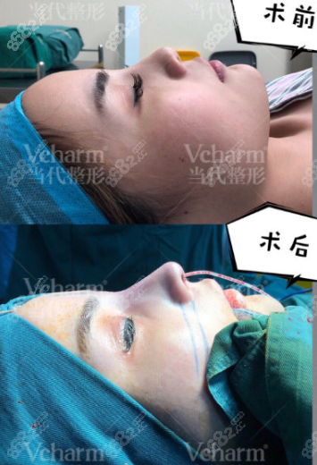 王旭明肋软骨鼻修复案例