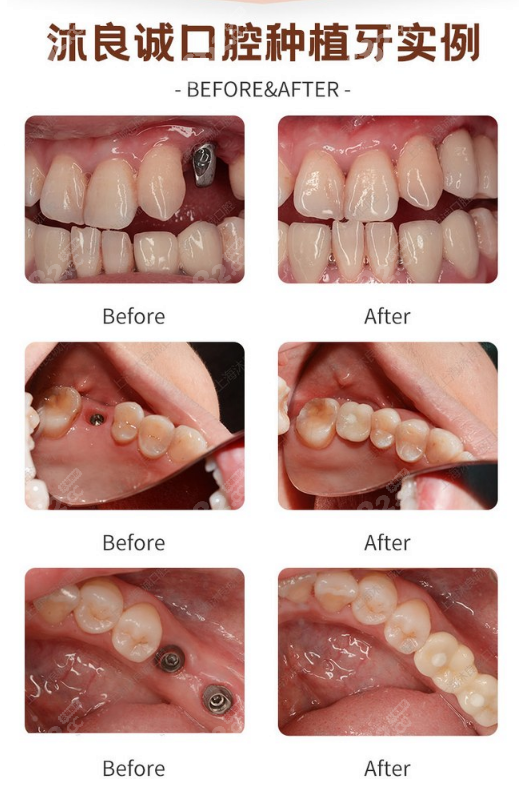 上海沐良誠口腔種植牙真人案例