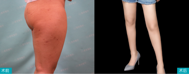 重庆星宸的吸脂技术决定了你抽大腿脂肪2000ml能瘦几厘米!