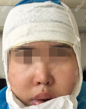 分享上海九院王旭东正颌偏颌手术成功案例 手术费用