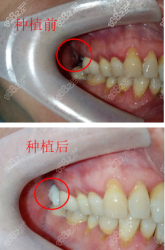 武大口腔種植牙案例二