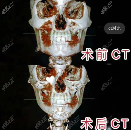 上下颌骨ct平扫解剖图片
