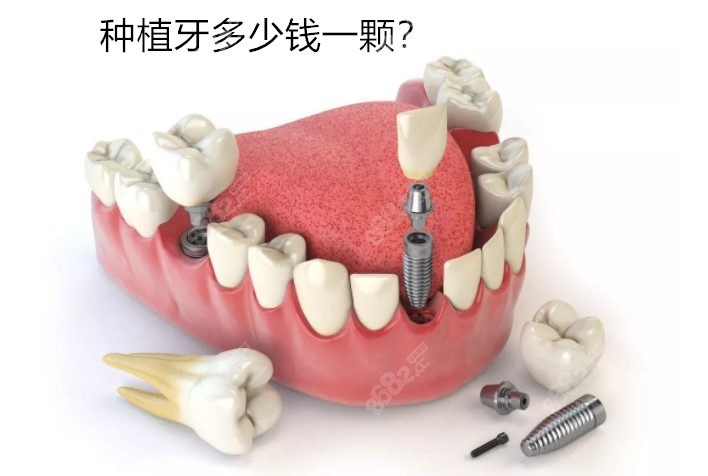 正規醫院種植牙收費標準已調整,哪裡種牙便宜技術好也有提