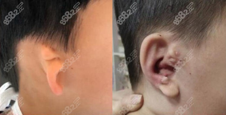 小耳症的人找北京八大处潘博做耳整形后挺好的,说他做小耳再造,隐耳