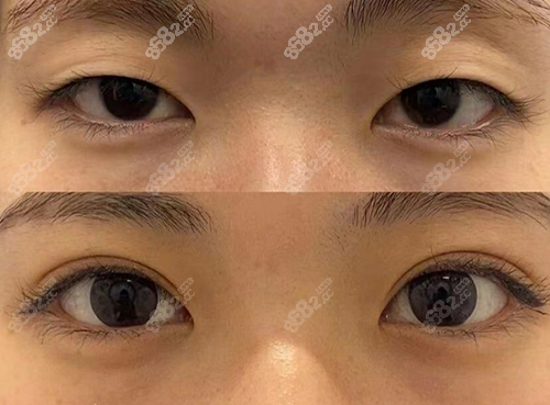 双眼皮手术对比图