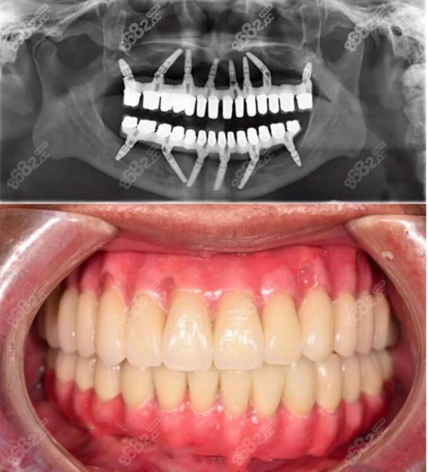 今日分享成都全口种植牙费用及比较好的口腔医院 86赴韩整形网
