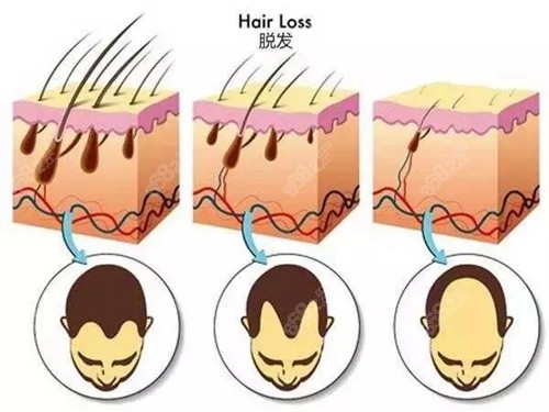 非那雄胺片治疗脱发真不靠谱,脱发没改善副作用还很大