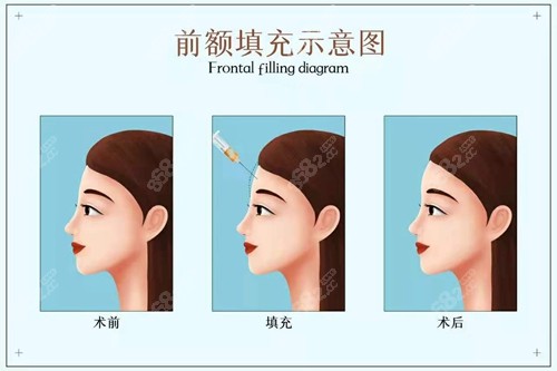 额头填充_填充额头永久的需要多少钱_填充额头用什么填是最好的