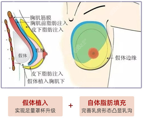 西安复合隆胸哪家医院好 画美傲诺拉假体 脂肪复合丰胸不错 86赴韩整形网