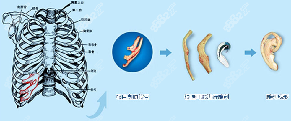 郭树忠医生以肋软骨作为耳再造的材料