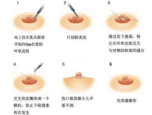 乳头内陷长见图片