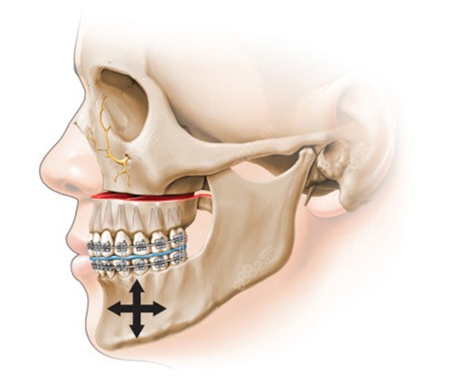 正颌手术改啥上下颌