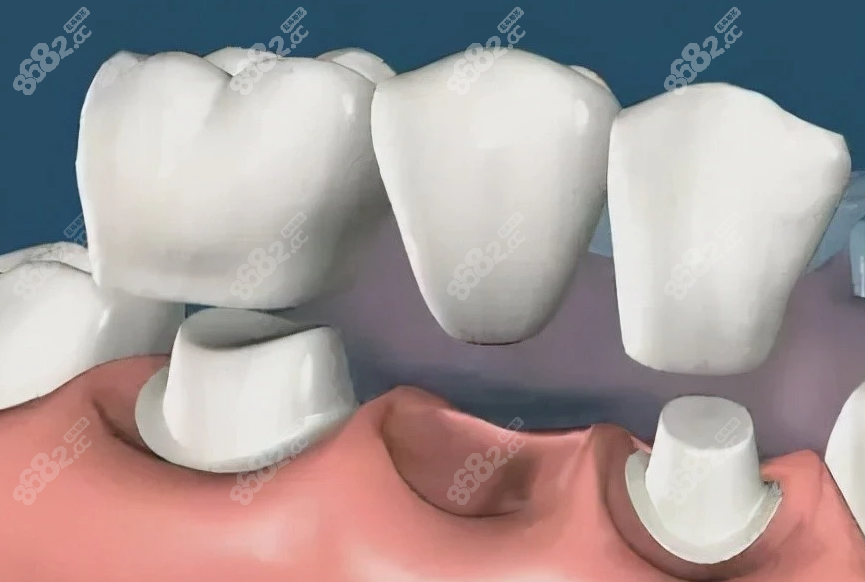 牙齿脱落后一直空着不补好吗缺牙修复选择镶牙or种植牙