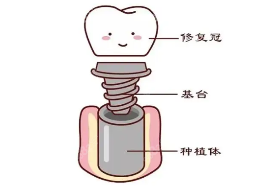 深圳同步齒科4000元的種植牙可靠嗎用的是韓國種植體嘛